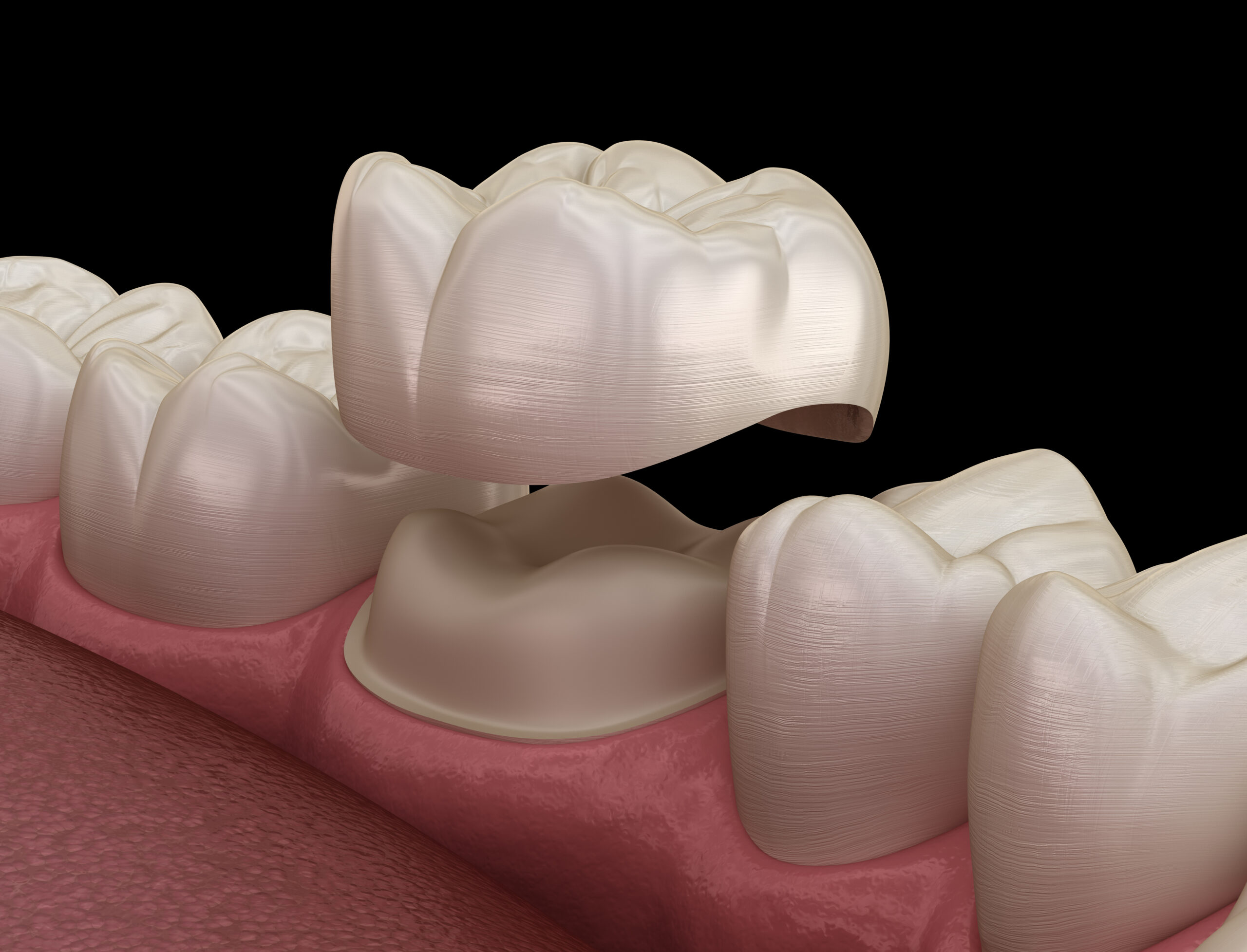 The Dental Symphony | Dental Crowns in Algonquin, IL: When a Damaged Tooth Needs More Than a Filling