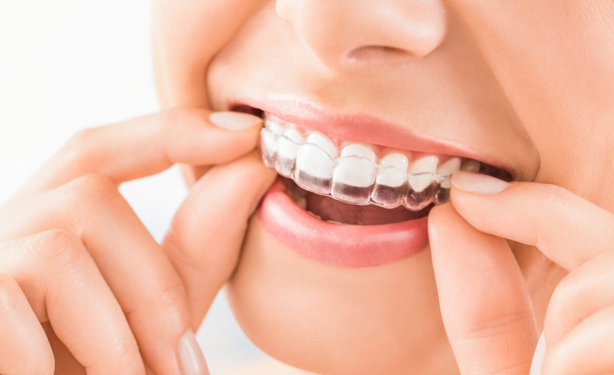 The Dental Symphony | Clear Aligners in Algonquin, IL: What to Expect During SureSmile® Treatment