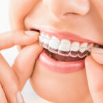 The Dental Symphony | Clear Aligners in Algonquin, IL: What to Expect During SureSmile® Treatment