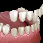 The Dental Symphony | Dental Veneers in Algonquin, IL: A Personalized Way to Transform Your Smile