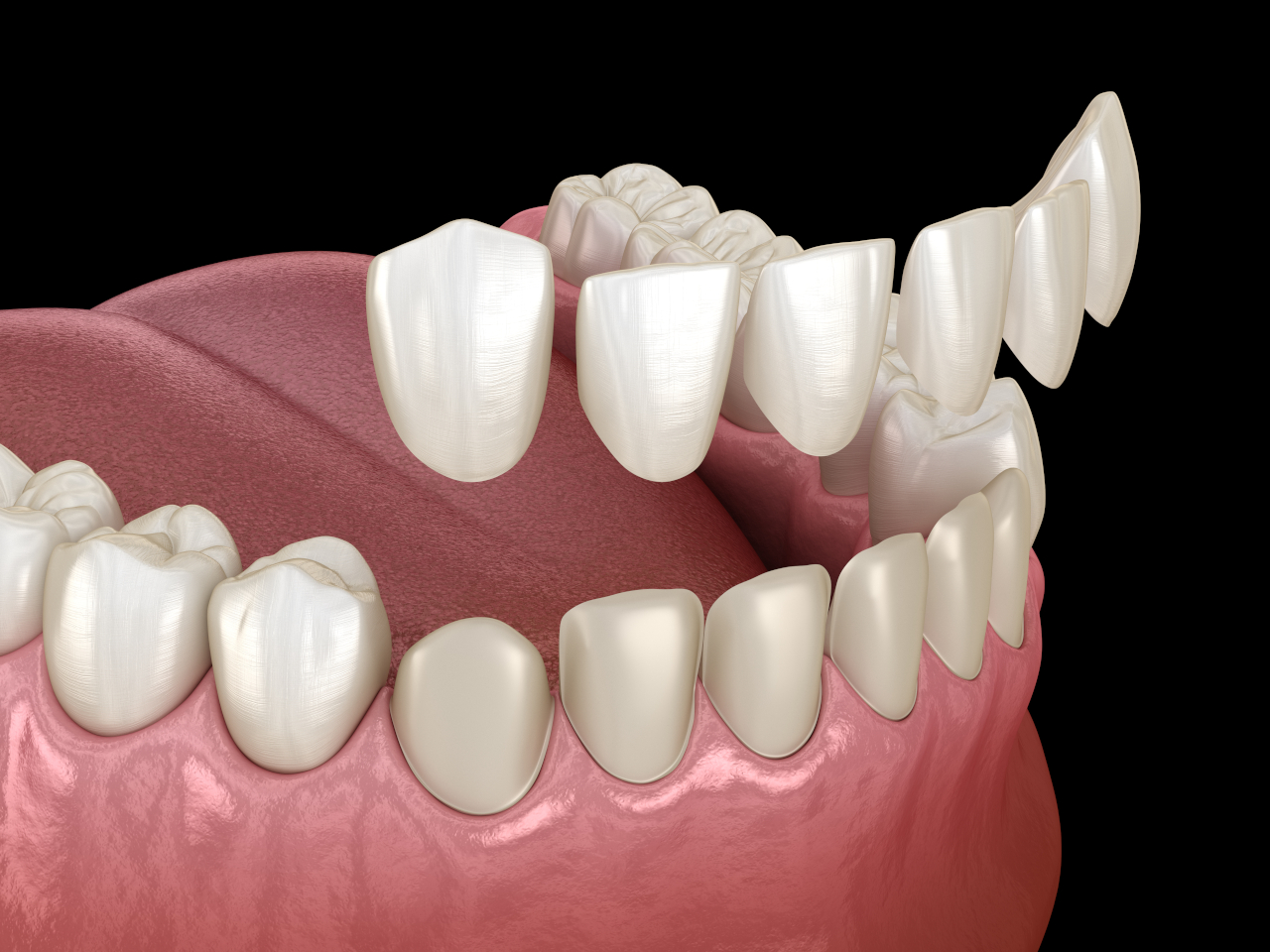 The Dental Symphony | Dental Veneers in Algonquin, IL: A Personalized Way to Transform Your Smile