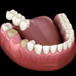 The Dental Symphony | Dental Bridges in Algonquin, IL: A Fixed Solution for Replacing Missing Teeth