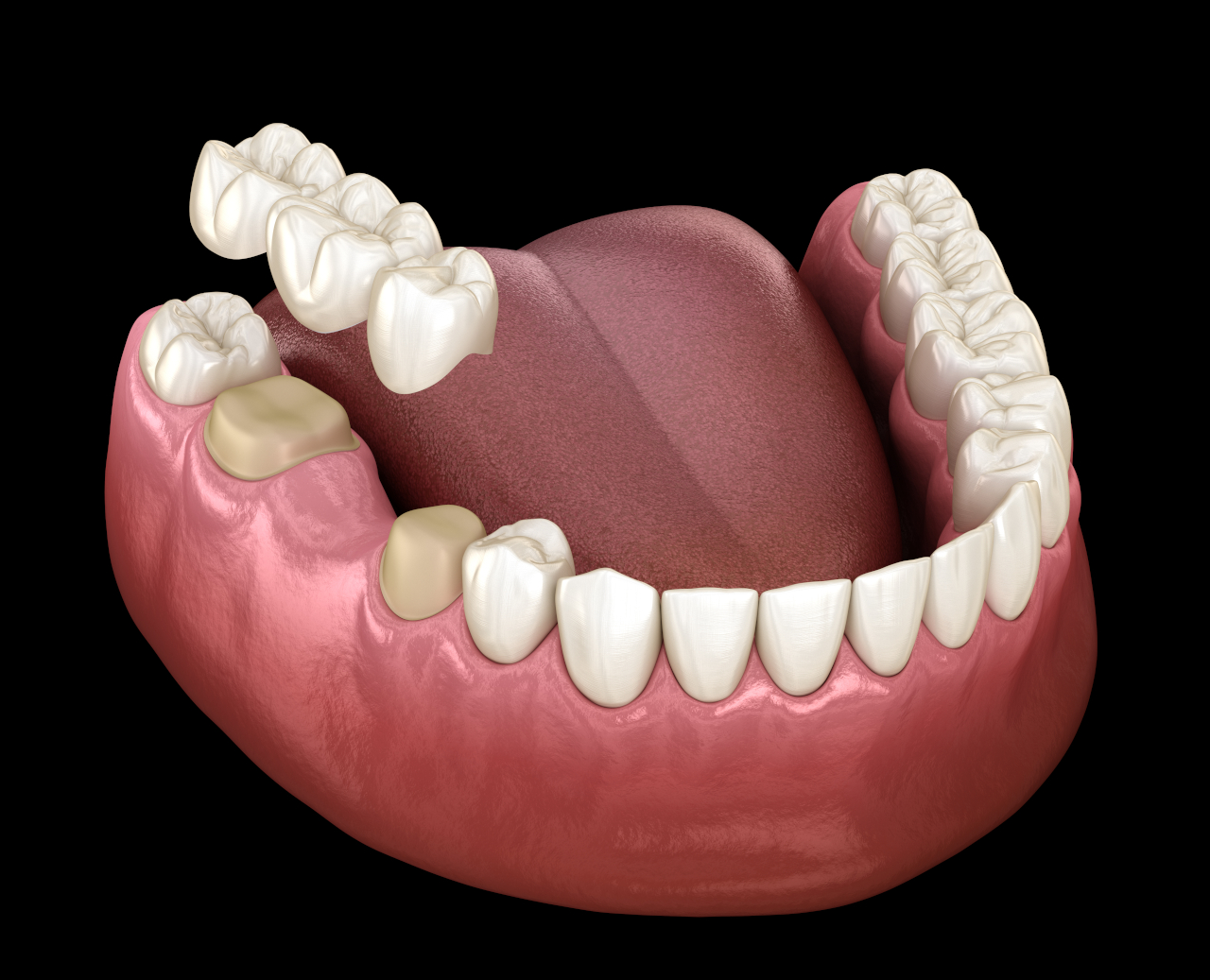 The Dental Symphony | Dental Bridges in Algonquin, IL: A Fixed Solution for Replacing Missing Teeth