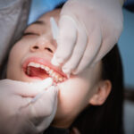 The Dental Symphony | Tooth-Colored Fillings in Algonquin, IL: Why Treating Cavities Early Matters